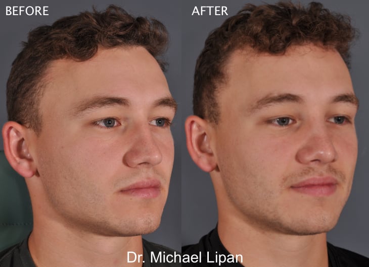 men rhinoplasty in florida